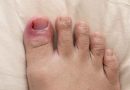 What treatment for ingrown toenails?