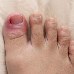 What treatment for ingrown toenails?