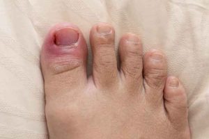What treatment for ingrown toenails?